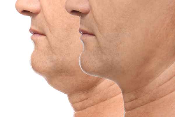 HIFU - Breakthrough in Anti - ageing 2 hifu results Dorchester