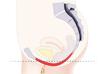 Pelvic-Floor Muscle Repair 5 Pelvic floor muscles Dorchester