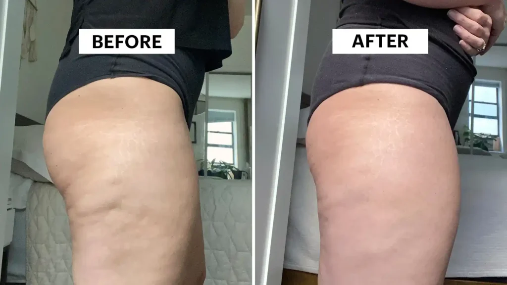 Sculpting Your Bum: Can Toning Exercises Really Reduce Cellulite? 1 Do Toning Exercise Dorchester Really Tackle Cellulite?