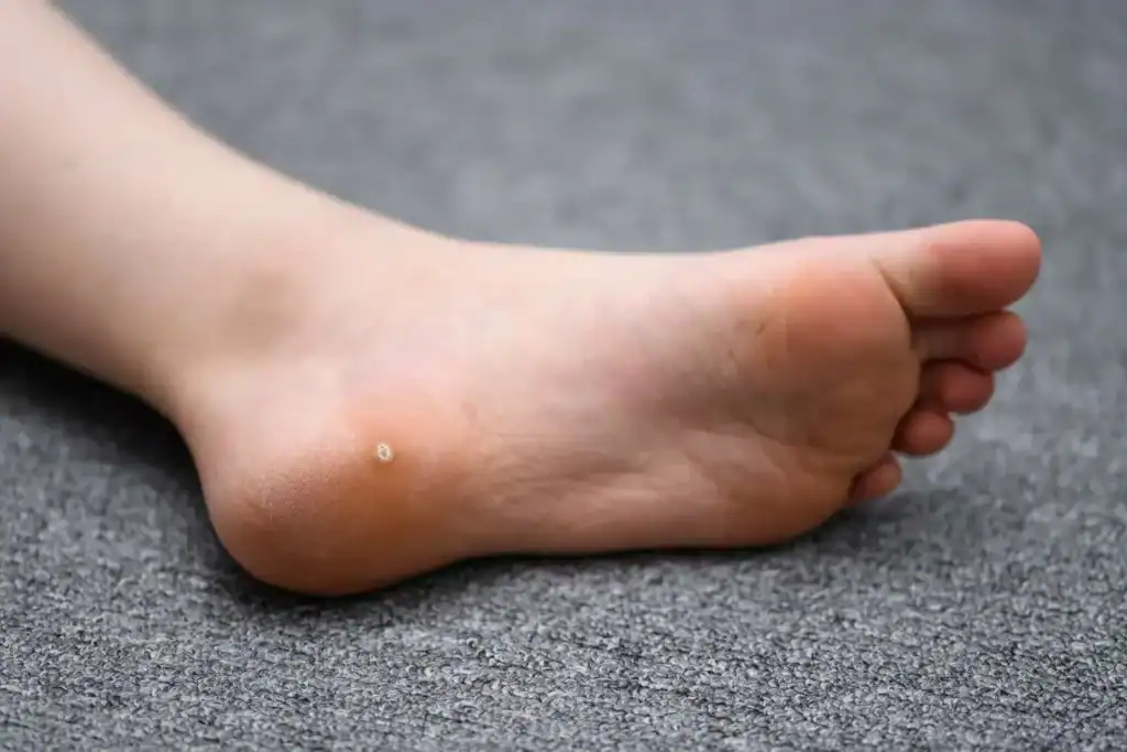 Cryotherapy For Warts And Also Verrucas 2 Image of verruca on the bottom of the foot that able to be treated with Cryotherapy Dorchester