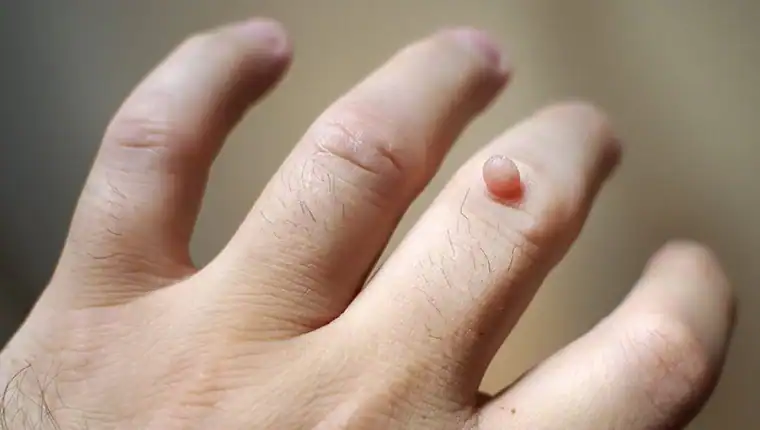 Cryotherapy For Warts And Also Verrucas 1 Image of blemish that Cryotherapy Dorchester can remove with Lipo 360.