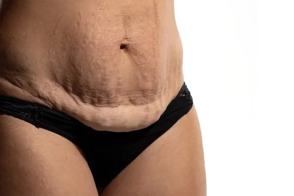 The Science of Skin Tightening 1 The science behind skin tightening Dorchester picture of a woman's sagging skin on the stomach